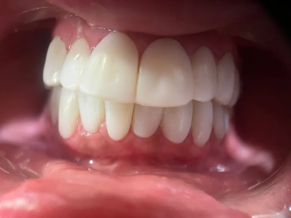 Before & After Teeth Whitening in Bodrum – after treatment photograph at MandarinDent